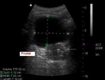 yüksek tansiyon ve prostat adenomu Karın ultrasonu yüksek tansiyonda ne gösterir?